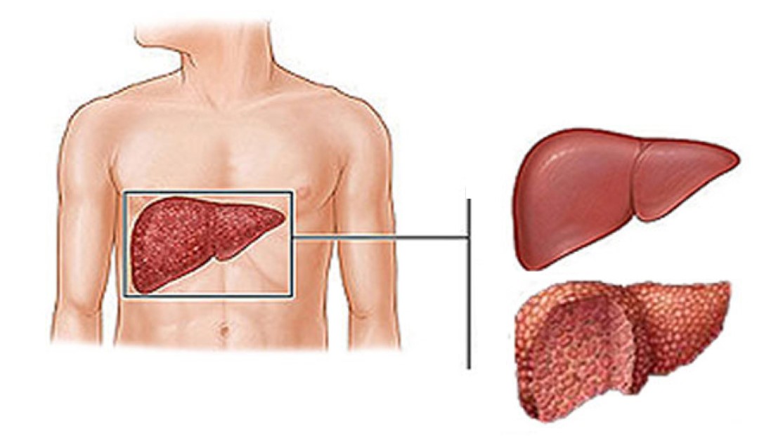 Хронический гепатит картинка